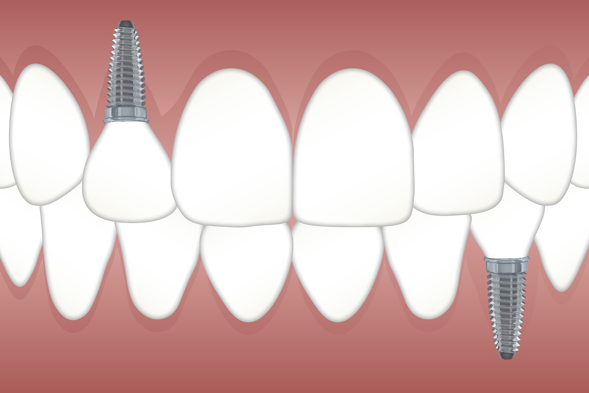 Dental Implants in Kenya